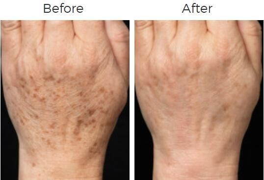 Fraxel Before & After