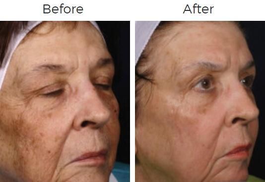 Fraxel Before & After