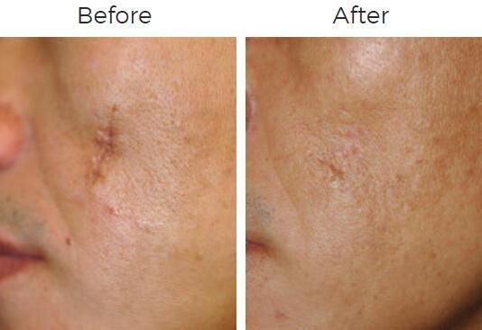 Fraxel Before & After
