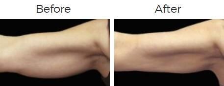 Coolsculpting Before & After
