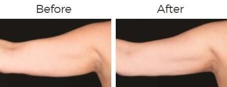Coolsculpting Before & After