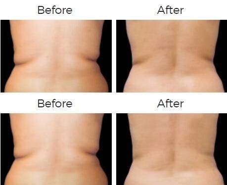 Coolsculpting Before & After
