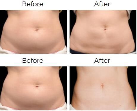 Coolsculpting Before & After