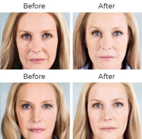 Sculptra Aesthetic Before & After