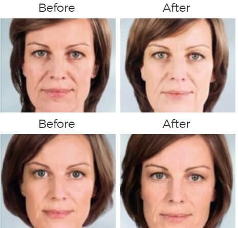 Sculptra Aesthetic Before & After