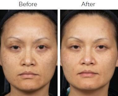 Clear Brilliant Before & After