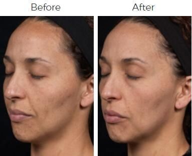 Clear Brilliant Before & After