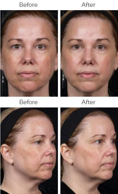 Clear Brilliant Before & After