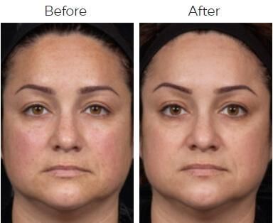 Clear Brilliant Before & After