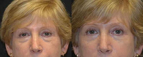 Blepharoplasty Before & After