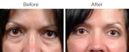 Blepharoplasty Before & After