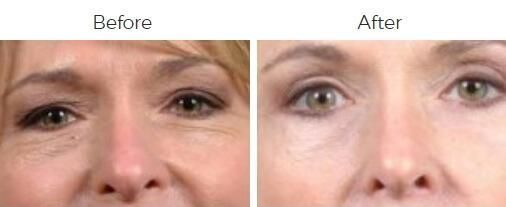 Blepharoplasty Before & After