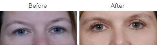 Blepharoplasty Before & After