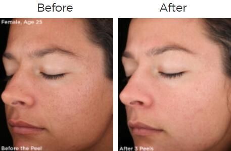 Rejuvenize Peel Before & After
