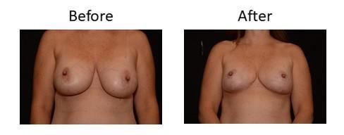 Breast Reduction Before & After