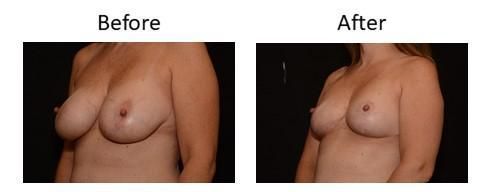 Breast Reduction Before & After