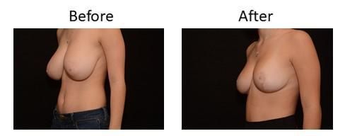 Breast Reduction Before & After