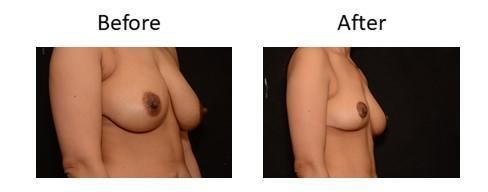 Breast Reduction Before & After